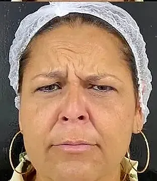 Toxina botulínica, antes