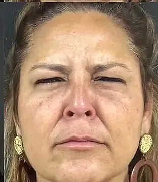 Toxina botulínica, depois
