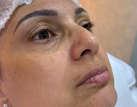 Olhar e região dos olhos, antes