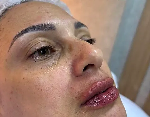 Olhar e região dos olhos, depois